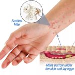 Беда Волчанска - педикулез